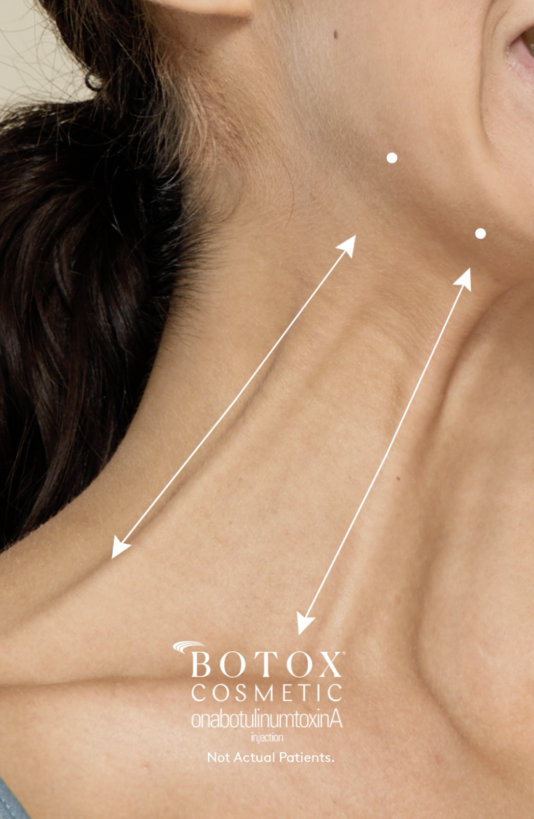 Botox Cosmetic's New FDA Approval: Treating Platysma Bands — All